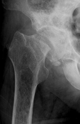 大腿骨近位部骨折のレントゲン写真